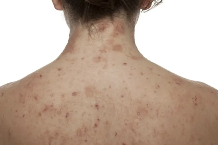 后背亚急性湿疹图