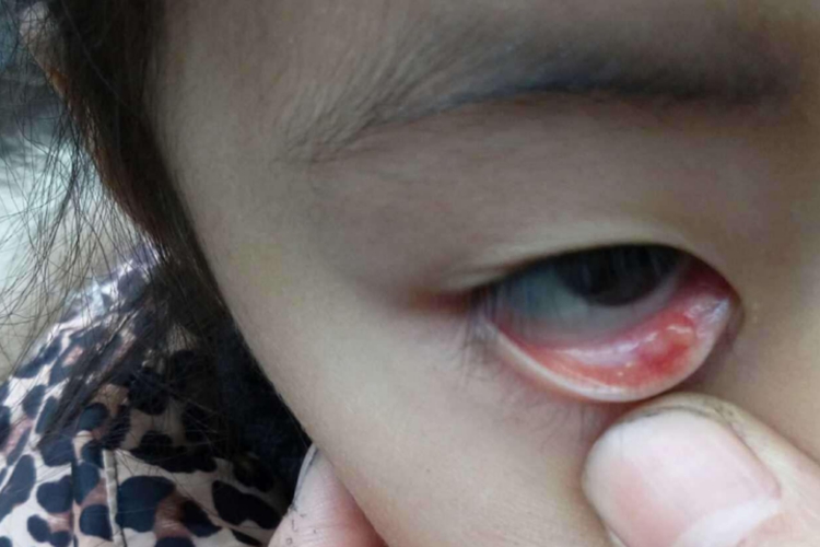 宝宝感染性结膜炎图