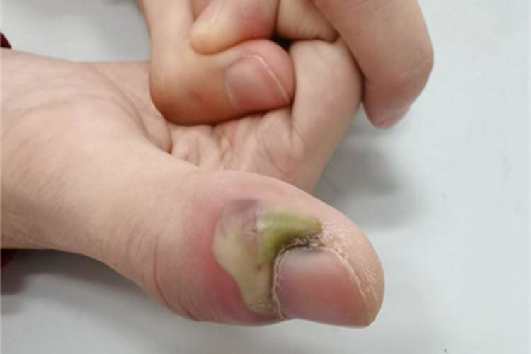 急性甲沟炎手指甲周围有脓图 急性甲沟炎手指甲周围有脓图