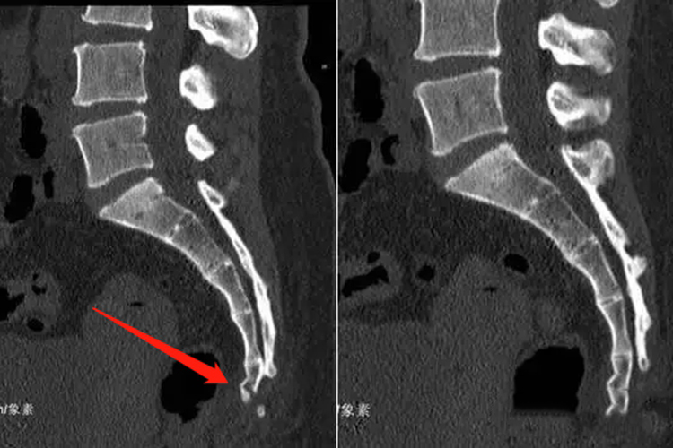 第5骶椎骨折位置图
