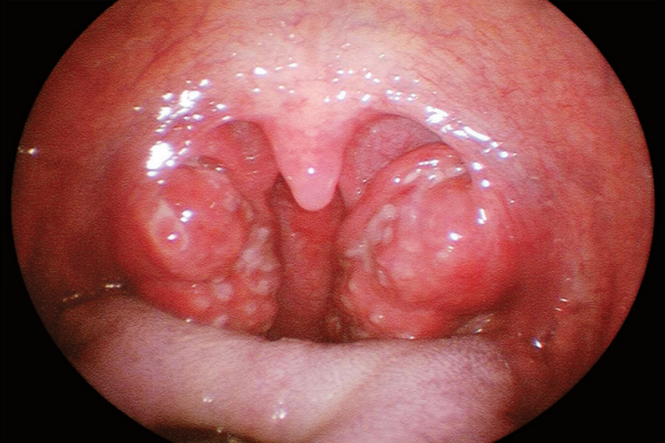 急性扁桃体炎图