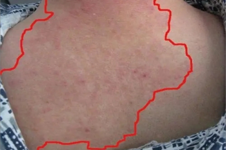 硬红斑后背大片红斑图 硬红斑后背大片红斑图