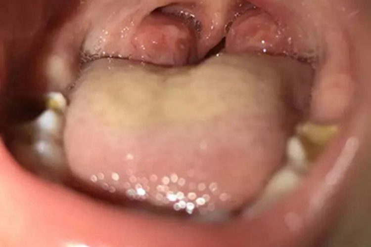 急性扁桃体炎包块图