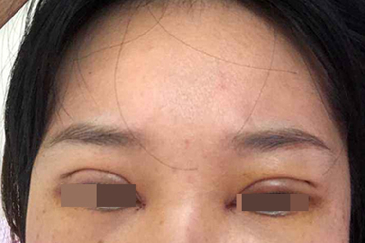 埋线双眼皮肿图