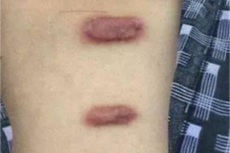 瘢痕疙瘩胸部长暗红色疙瘩图