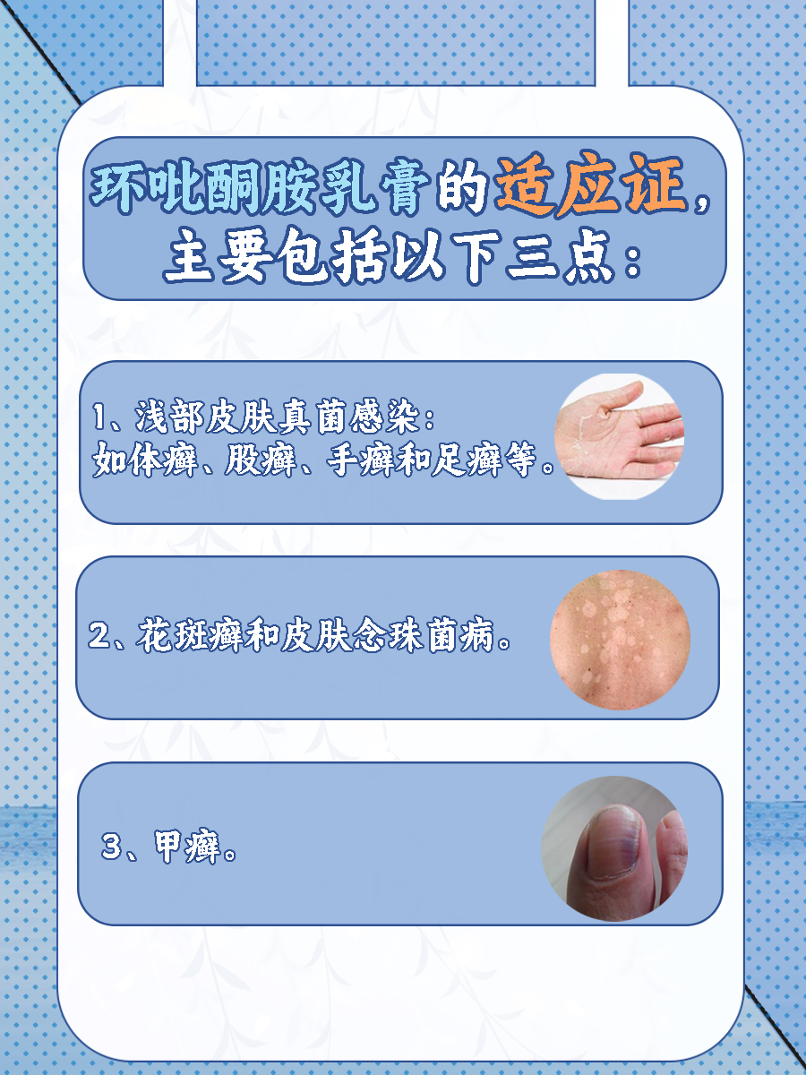 有脚气！环吡酮胺乳膏能治疗吗?