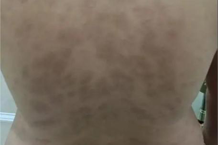 黑变病背部长斑图 黑变病背部长斑图