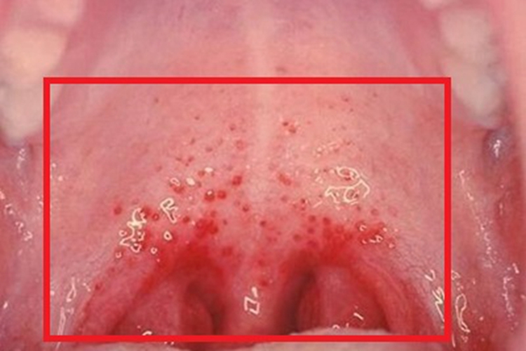 疱疹性咽峡炎血点图