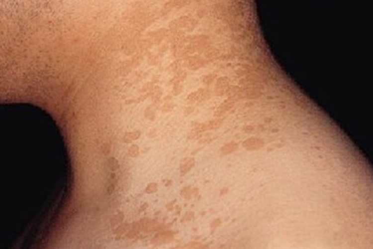 脖子上花斑癣出现不规则形褐色斑块图