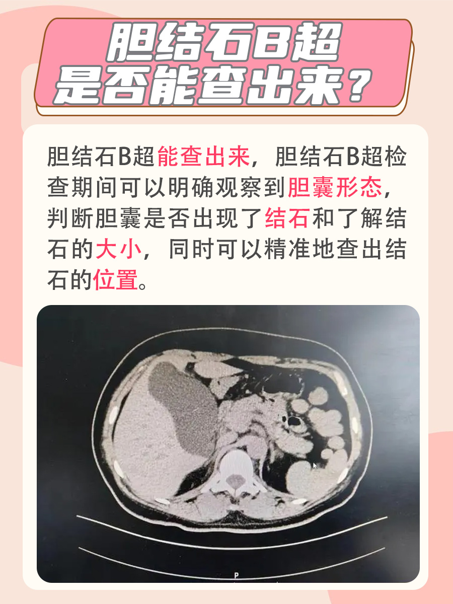 一起了解：胆结石B超能查出来吗？