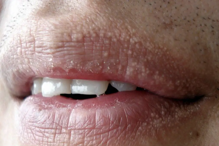 口唇部皮脂腺异位症图