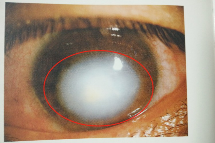 角膜变性角膜斑图