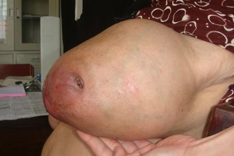 乳腺癌肿物不规则外观图