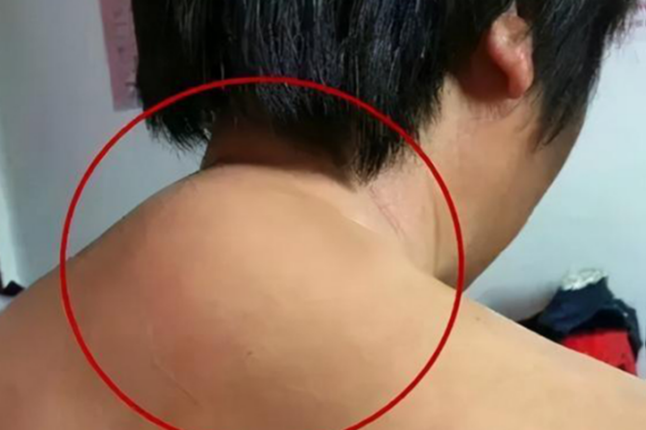 富贵包症状明显图