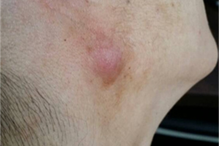 面颈部放线菌病大红疙瘩图