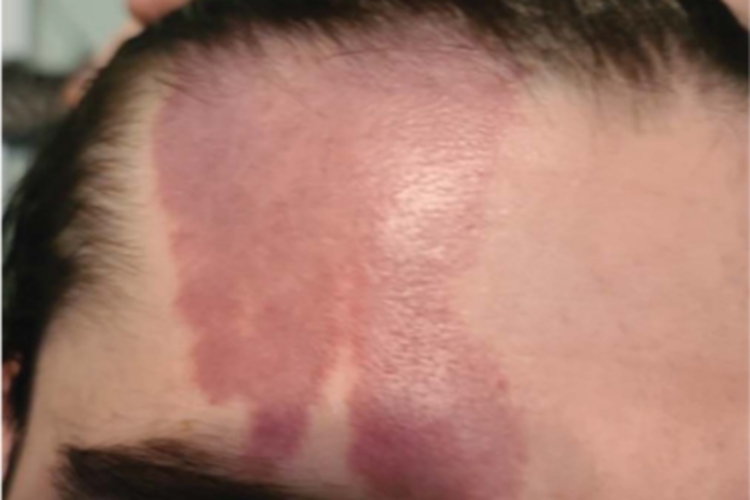 头-面血管瘤综合征前额有红斑图