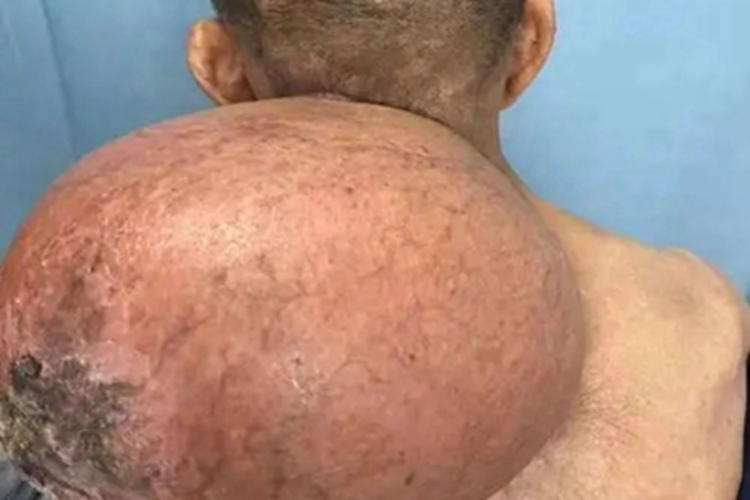 恶性纤维组织细胞瘤大包图 恶性纤维组织细胞瘤大包图