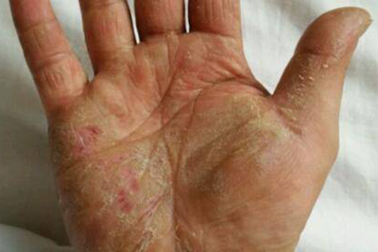 鳞屑角化型手癣图