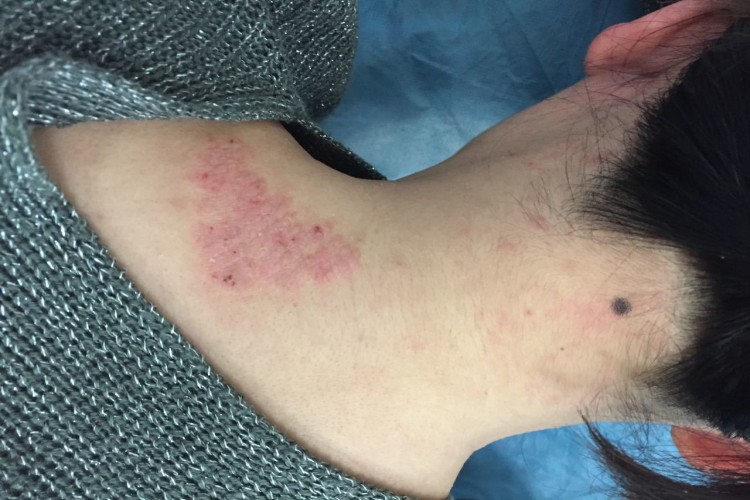 湿疹肩部丘疹图