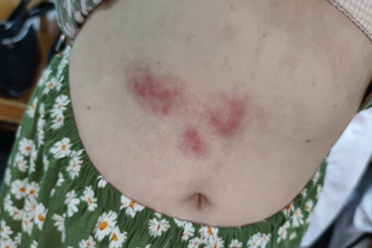 带状疱疹右侧肚子红斑丘疹图 带状疱疹右侧肚子红斑丘疹图