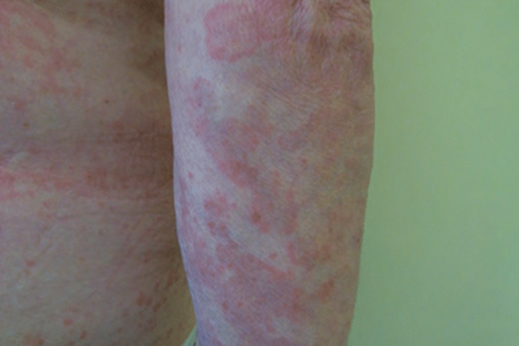 荨麻疹性血管炎红斑图