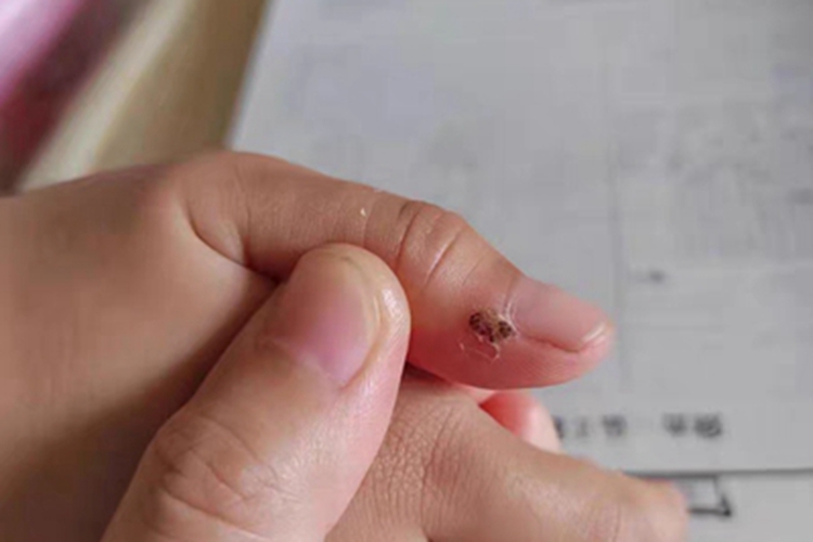 寻常疣手指甲结节图