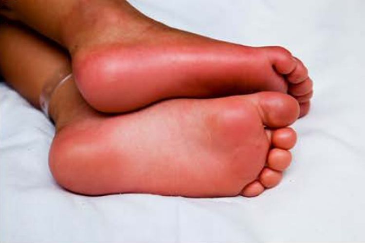 川崎病足硬肿图 川崎病足硬肿图