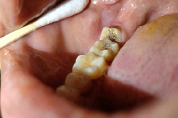 浅龋牙齿表面有黑褐色沉积图