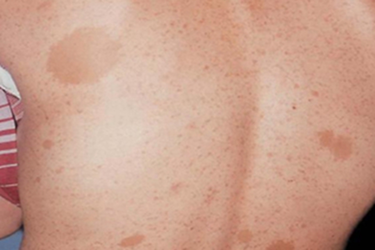 咖啡斑背部症状图