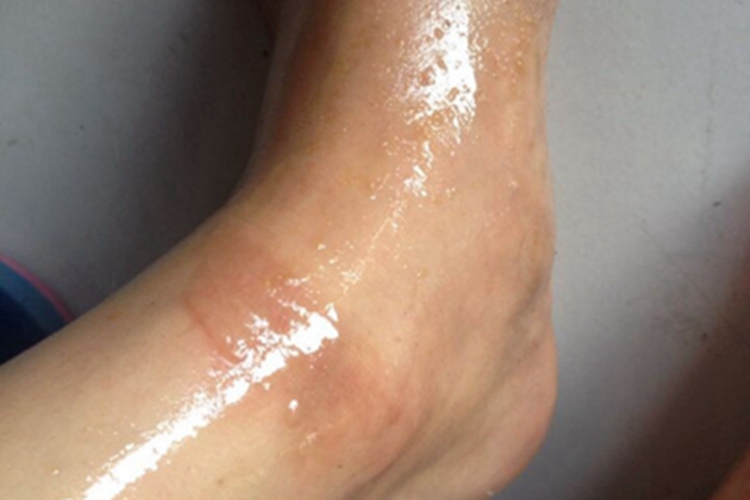 一度烫伤脚踝症状图 一度烫伤脚踝症状图