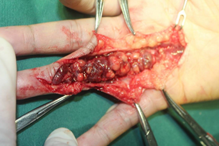 腱鞘巨细胞瘤手指有很多小疙瘩图