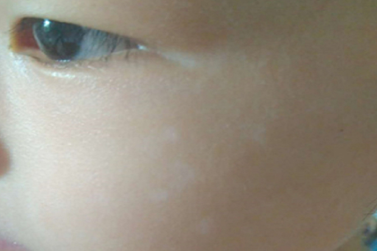 无色素痣小儿白斑初期图