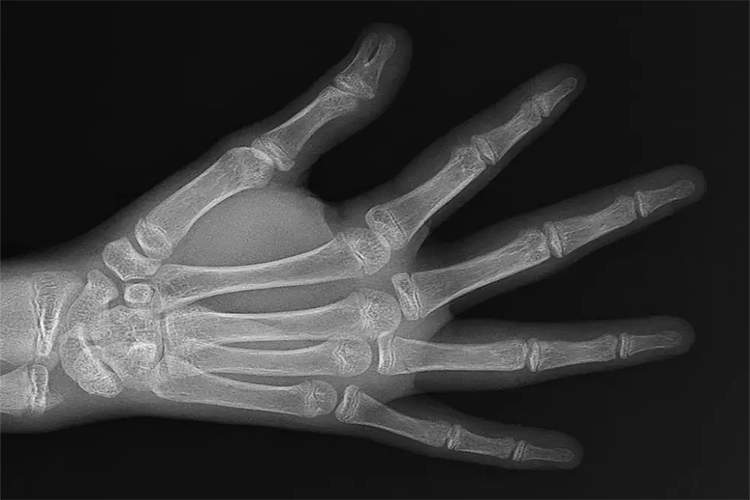 手部骨骺线闭合图