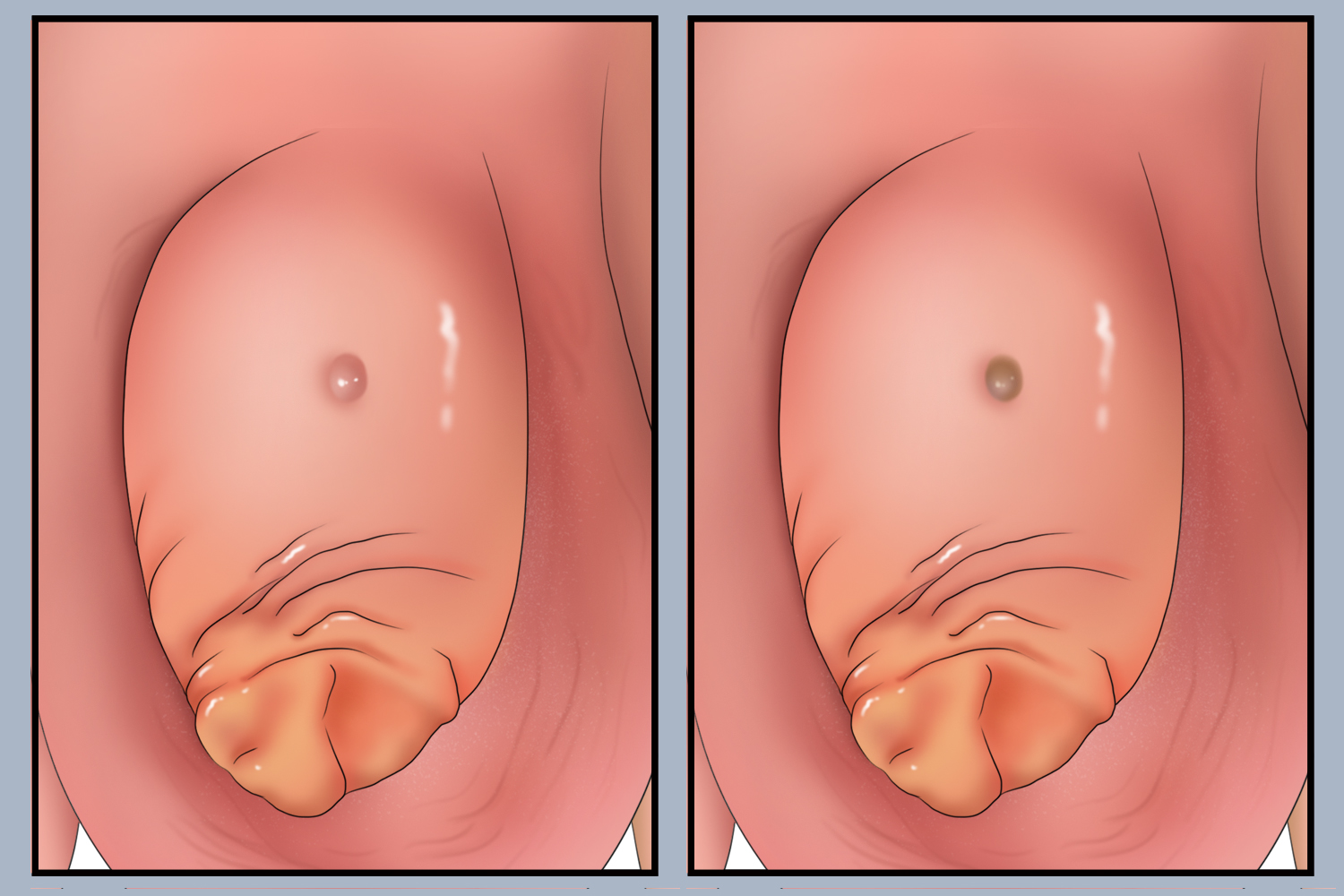 阴茎软纤维瘤图