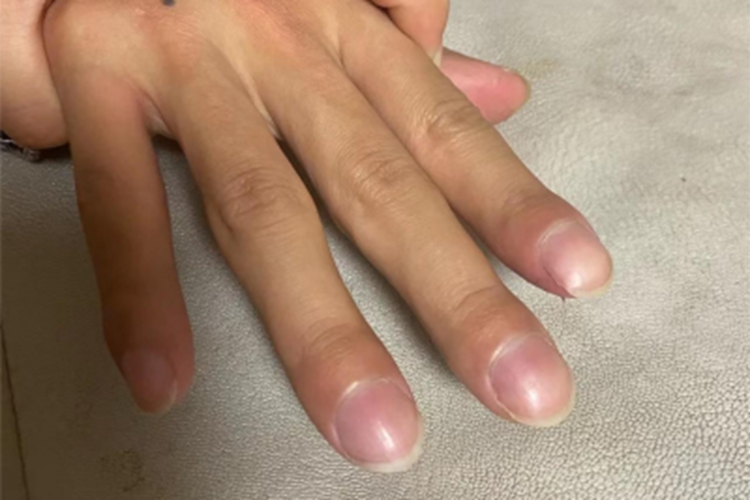 杵状指手指症状图 杵状指手指症状图