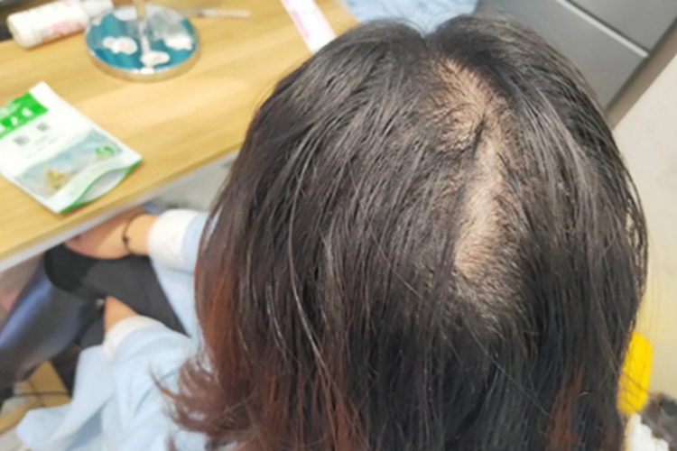 油风脱发头顶露出皮肤图