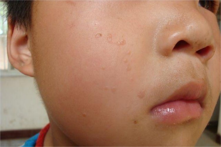 小孩扁平疣脸上疙瘩图