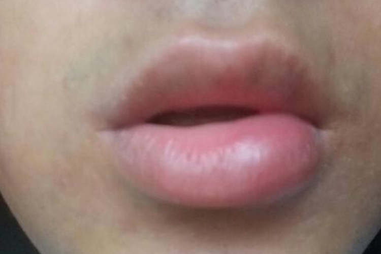 豌豆过敏唇肿图