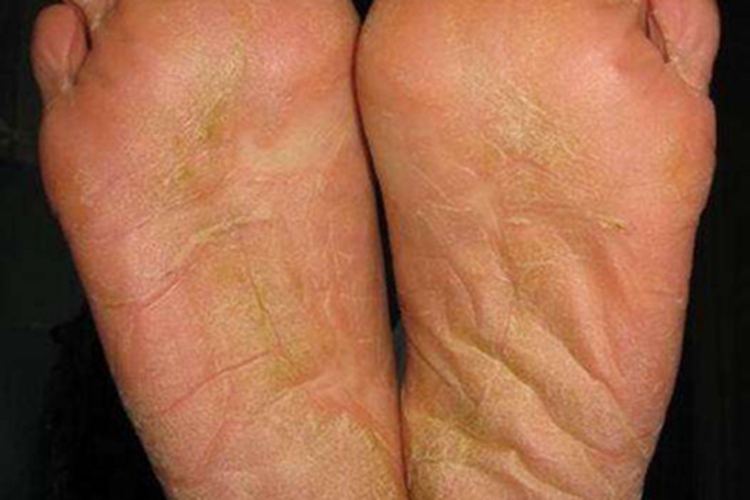 砷角化病脚底症状图