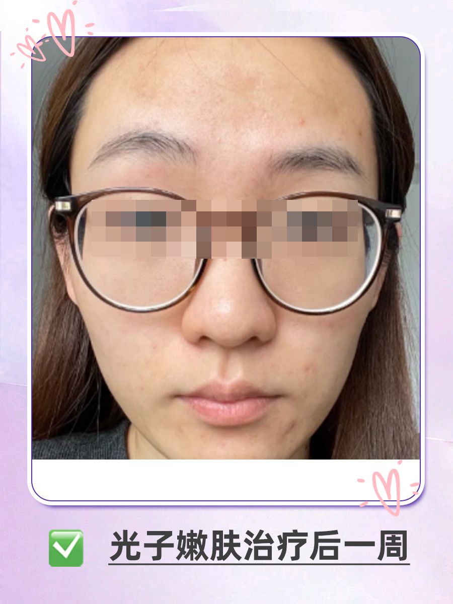战痘女孩看过来：祛除痘印前后对比图片~