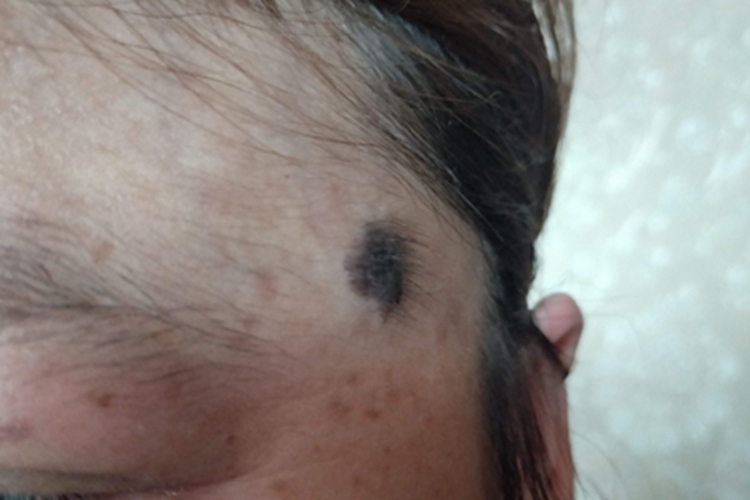 复合痣脸上有黑痣长毛图