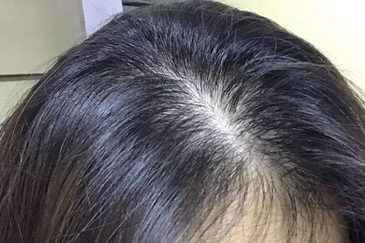 女性脂溢性脱发Ⅰ级图 女性脂溢性脱发Ⅰ级图