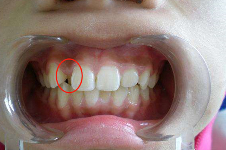 侧切牙内凹图 侧切牙内凹图