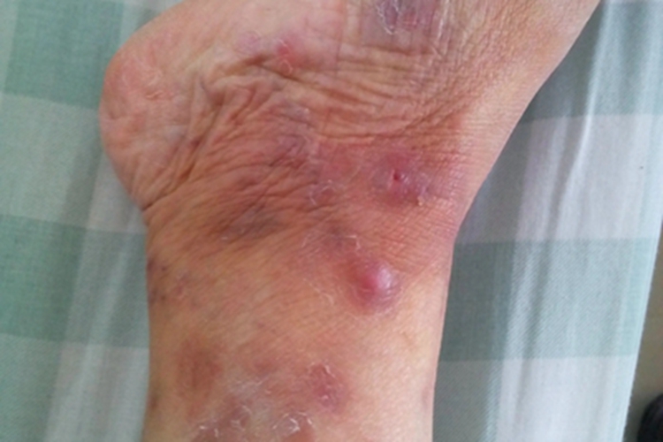 结节性多动脉炎紫斑图