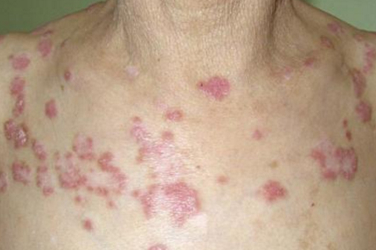 脖子下面红红一片图