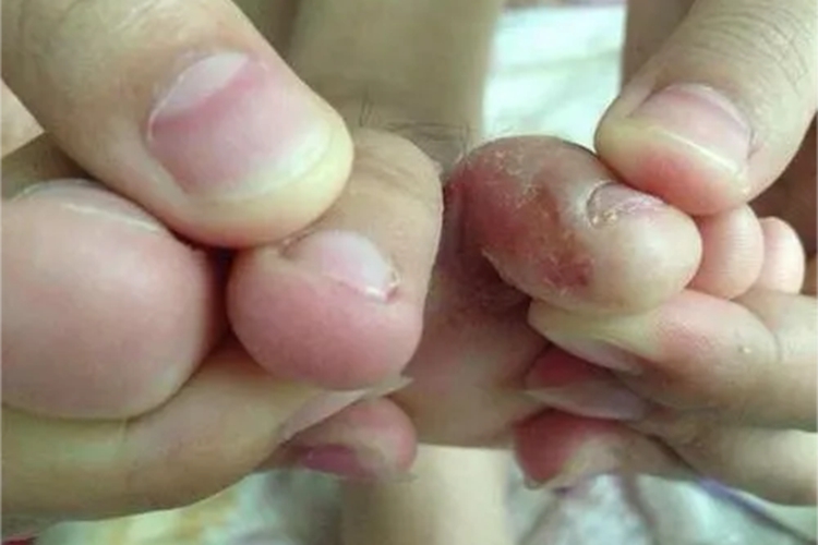 巴尔通体病脚趾缝症状图