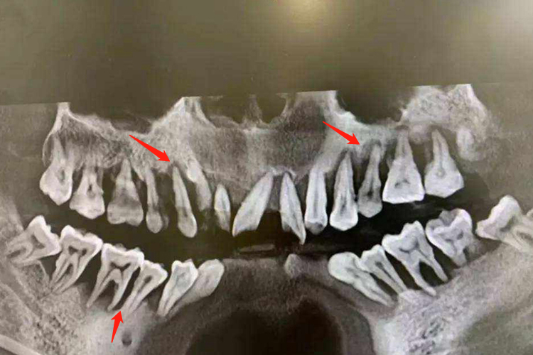 牙槽骨吸收重度影像图 牙槽骨吸收重度影像图