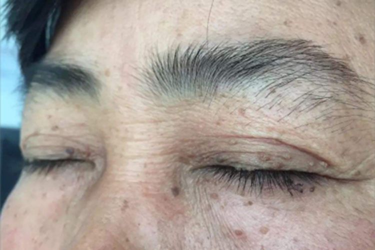 丝状软纤维瘤眼周症状图 丝状软纤维瘤眼周症状图