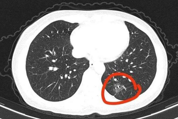 早期肺癌ct表现图