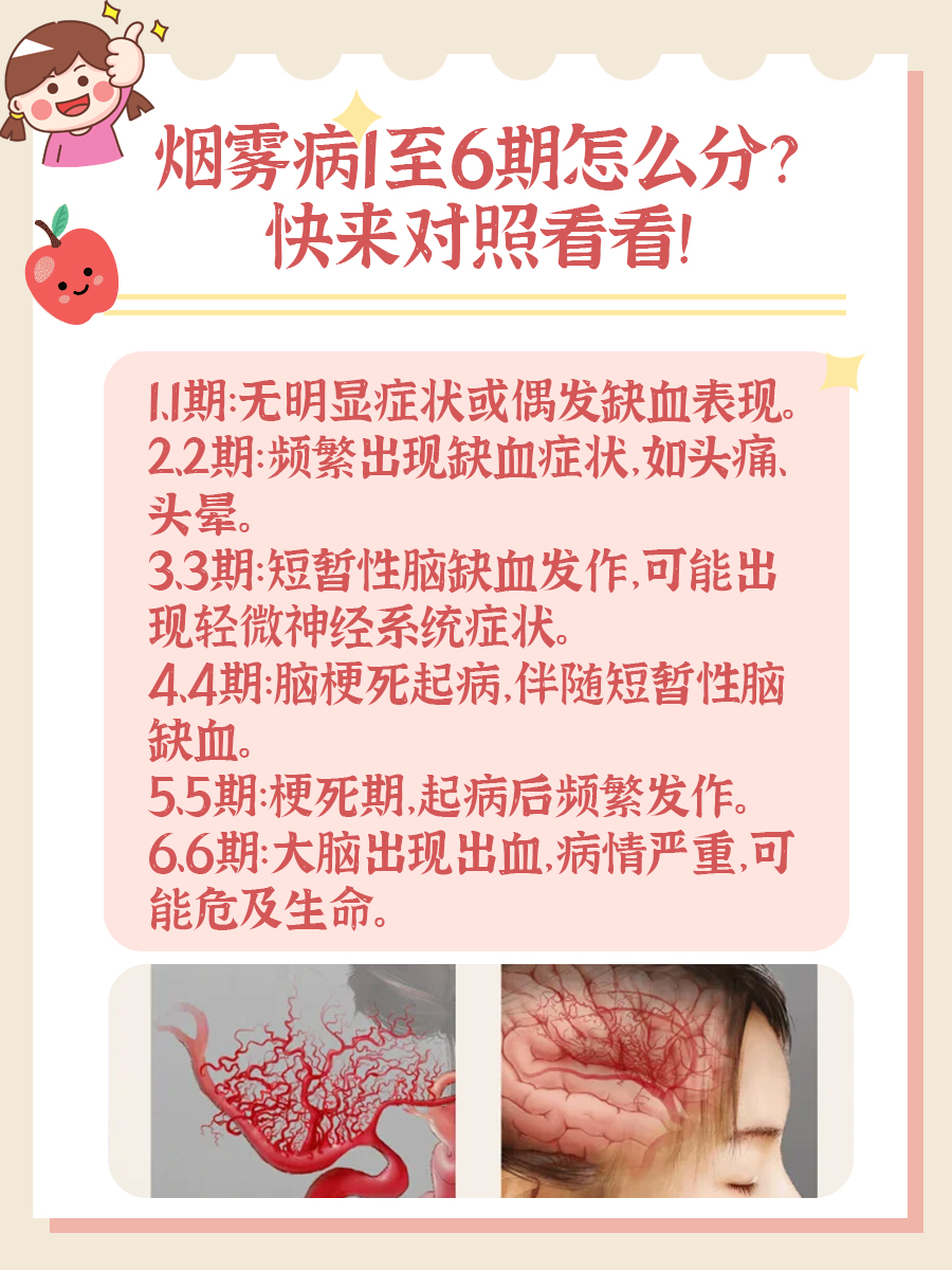 烟雾病1至6期怎么分？快来对照看看！